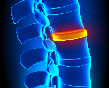 Upper Back Pain  DISC Spine Institute TX